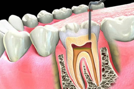 Root Canal Treatment in Balewadi